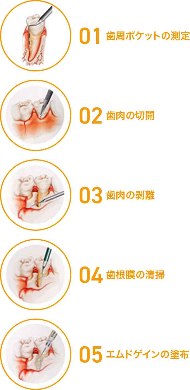 歯周外科手術とエムドゲインゲルの塗布