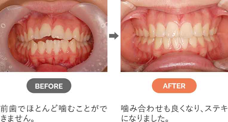 開咬（オープンバイト）奥歯は噛んでもいても、前歯が開いている状態です